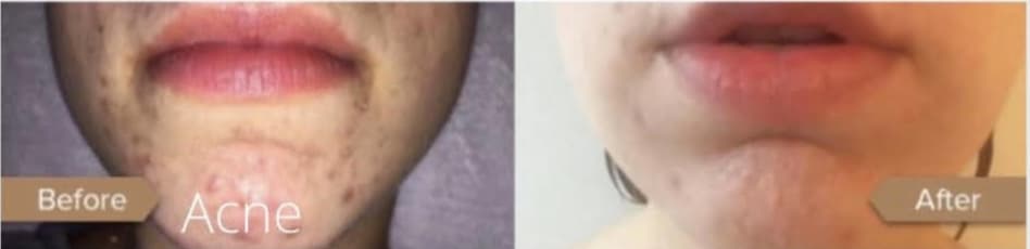 Before and after photos of someone's improved acne after an Alumier treatment.