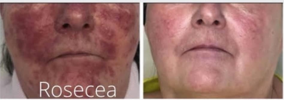 Before and after photos of someone's improved rosacea after an Alumier treatment.