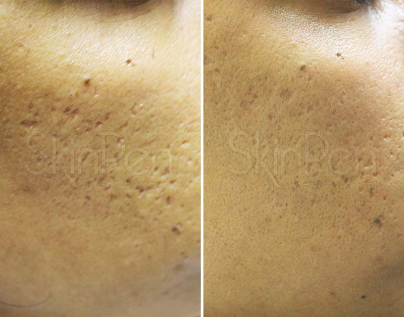 Before and after photos of someone's improved ageing signs after an Alumier treatment.