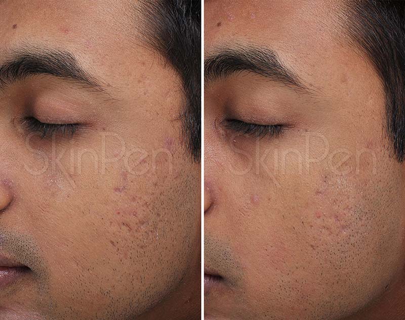 Before and after photos of someone's improved rosacea after an Alumier treatment.
