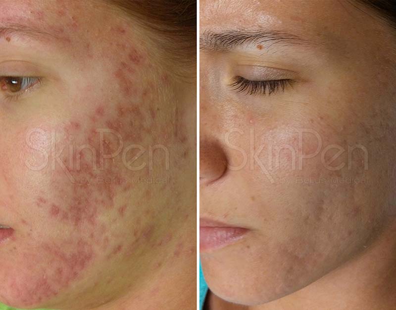 Before and after photos of someone's improved ageing signs after an Alumier treatment.